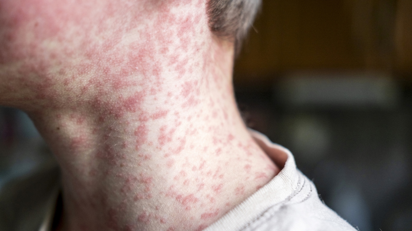 When measles cases rise in the USA, some adults may need a vaccine amplifier: shots