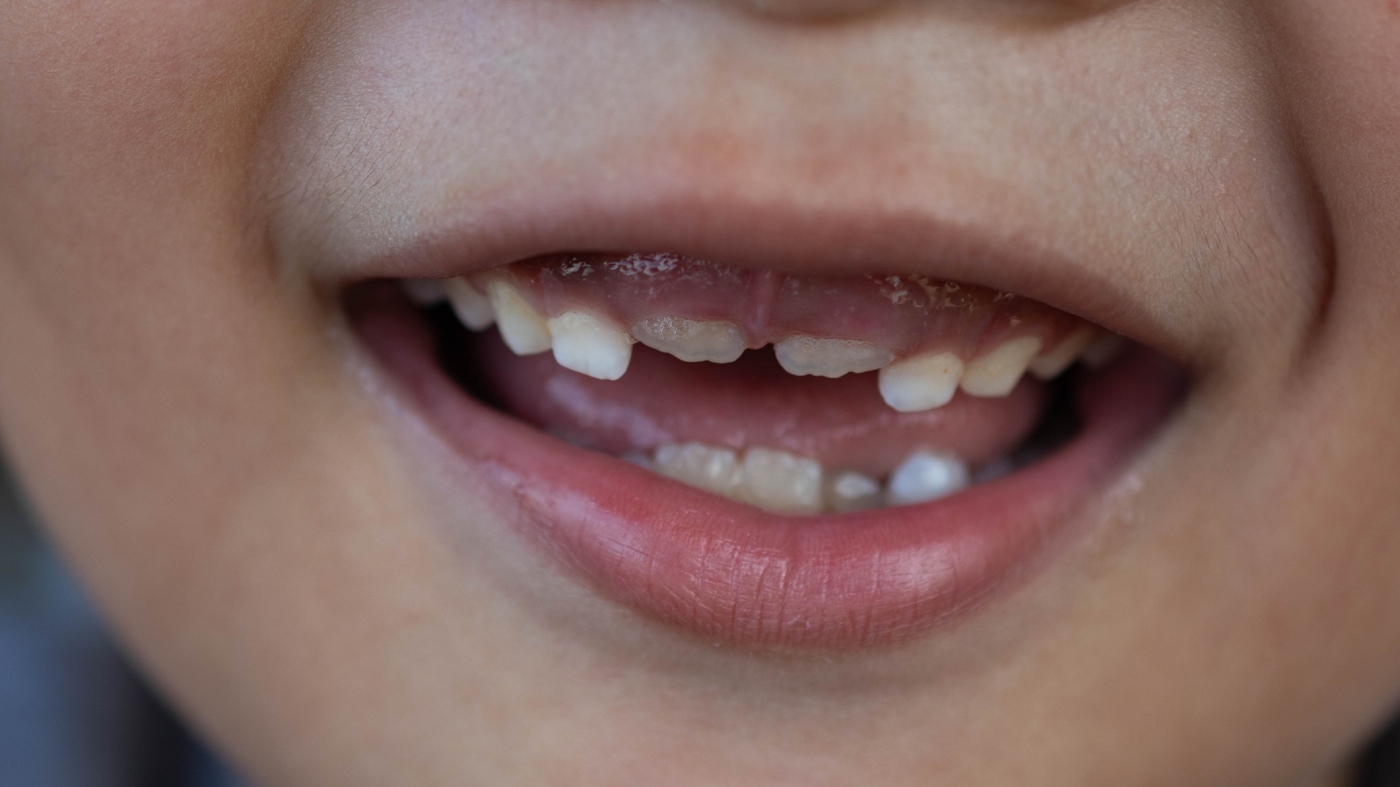 FDA moves to ban fluoride preparations for children and to remove an important tool for dentists: recordings
